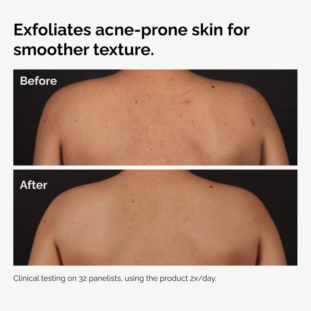 Salicylic Acid Body Serum Targeted Serum Care Q5